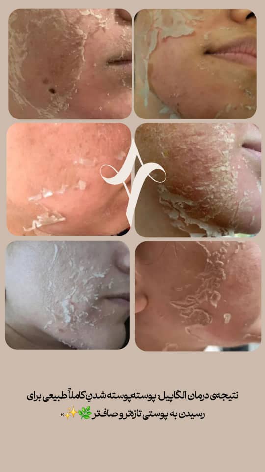 خدمات پاکسازی و درمان پوست یلدا اکبری در شیراز